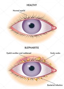 blepharitis
