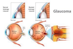 glaucoma