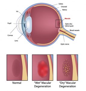 macular-degeneration