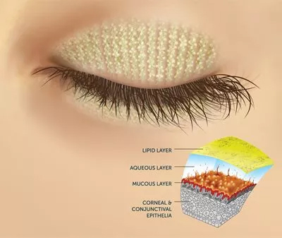 dry-eye-image